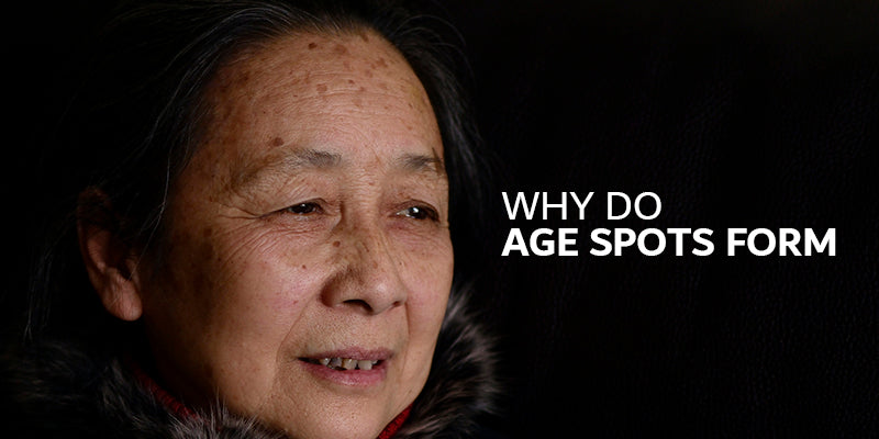 Why do age spots form?